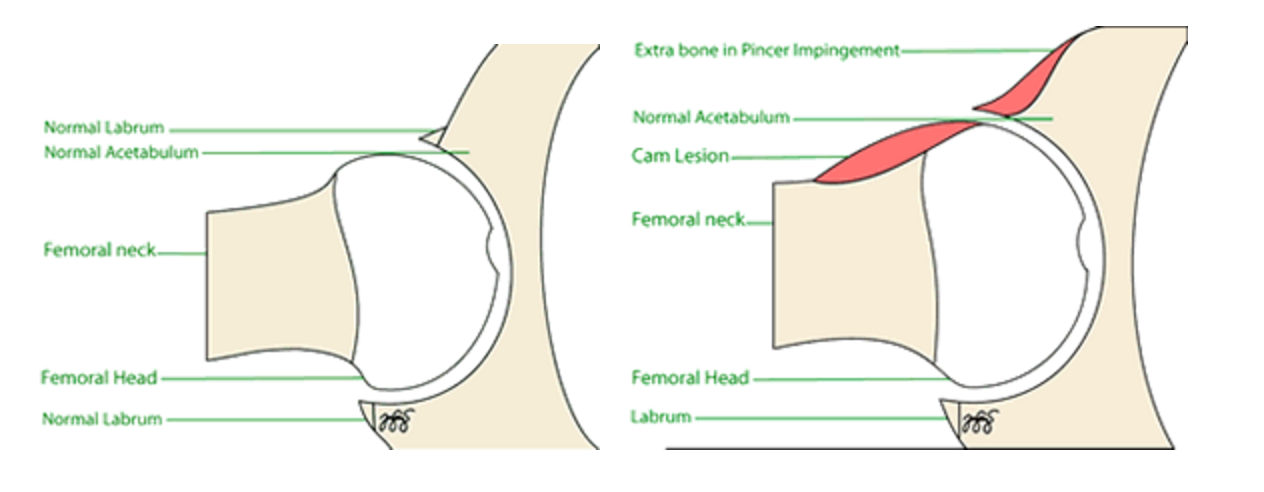 Femoroacetabular Impingement